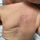 Rash on a baby's back
