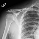 Neck and Shoulder Pain After a Mountain-Biking Fall