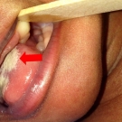 Neonate With Bilateral Dental Lamina Cysts