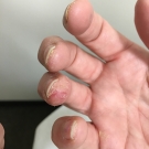 Allergic Contact Dermatitis to Acrylate Chemicals in Artificial Nails