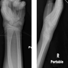Hypocalcemic Seizures in an Adolescent With Autism Spectrum Disorder