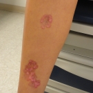 Necrobiosis Lipoidica