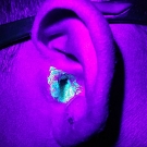 AOM due to P aeruginosa with tympanic perforation