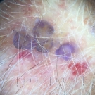 Purple Papules on a Man's Scalp