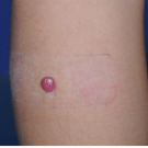 Spitz Nevus