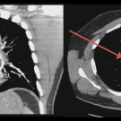 DVT and PE from Binge Gaming