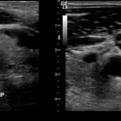 Spontaneous Bilateral Internal Jugular Vein Clots With 2 Causes of Hypercoagulability