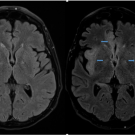 Fulminant Herpes Simplex Encephalitis