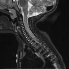 Acute Flaccid Myelitis