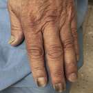 Hydroxyurea-induced melanonychia