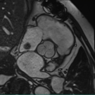 right-atrial-myxoma-long-journey-diagnosis-surgery