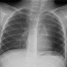 Mucoepidermoid Carcinoma