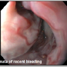 Portal Hypertension–Induced Varices in a Well-Appearing Child