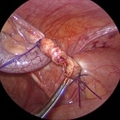 Appendiceal Enterobius vermicularis Mimicking Acute Appendicitis in an 8-Year-Old Girl