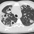 Innumerable Septic Pulmonary Emboli