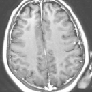 Anti-NMDA Encephalitis