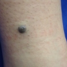Photo Essay - Blue Nevus