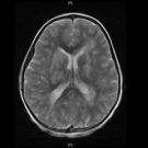 Acute Disseminated Encephalomyelitis