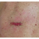 Extracardiac Rhabdomyoma and Spindle-Cell Lipoma of the Upper Back