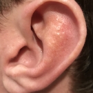 Herpes Simplex Virus Infection of the External Ear