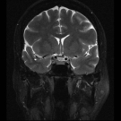 Neurovascular Compression of the Optic Nerve