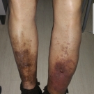 Chronic Venous Ulcer Treated With Iliac Vein Stenting for Proximal Deep Vein Compression