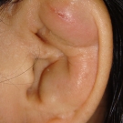 Ear Lesion