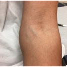 Congenital Posterior Dislocation of the Radial Head