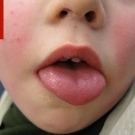 toxin-mediated erythema