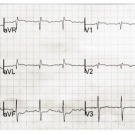 Brugada Syndrome