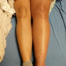 Iliofemoral DVT Progressing to Phlegmasia Cerulea Dolens in a Woman With May-Thurner Syndrome