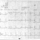 Acute Pericarditis