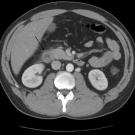 Pancreatitis Caused by Campylobacter Enteritis