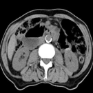 Duodenal Adenocarcinoma