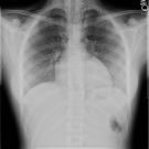 Pneumomediastinum