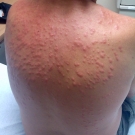 bed bugs