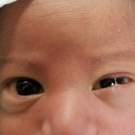 Ankyloblepharon Filiforme Adnatum