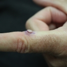 What Is the Growth on This Man’s Finger?