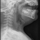 retropharyngeal-tear