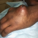 Retained Foreign Body in the Hand