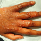 Bullous Tinea