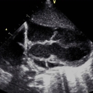 Pulmonary Atresia With Ventricular Septal Defect and Major Aortopulmonary Collateral Arteries