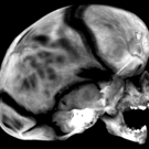 sagittal-craniosynostosis-scaphocephaly