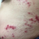 Levamisole Toxicity From Adulterated Cocaine