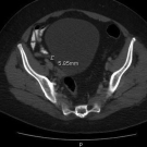 Atypical Appendicitis Preceded by Viral Illness