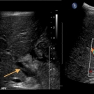 hypercalcemia-induced-pancreatitis-4-year-old