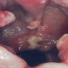 Solitary Rectal Ulcer Syndrome With Polyposis