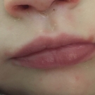 Atypical Hand-Foot-and-Mouth Disease