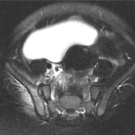 Pneumococcal Osteomyelitis in a Vaccinated Immunocompetent Child