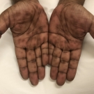 A Woman With a Rash on Her Palms and Soles